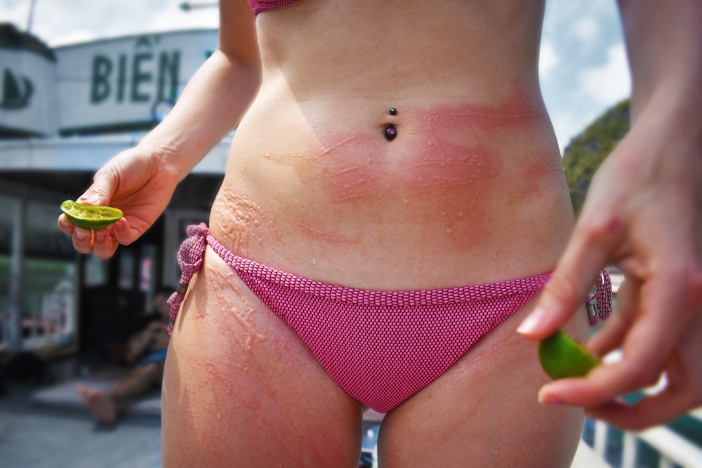 Изгарянията от медузи изглеждат ужасно. Оцетът или лимонът могат да помогнат