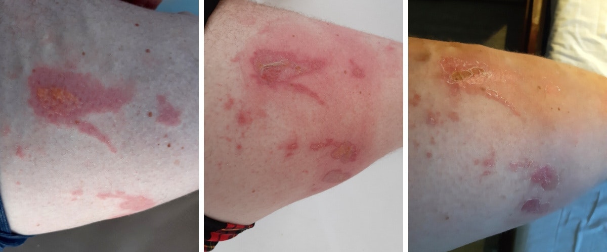Požahání medúzou (zleva) 1. čerstvé poranění, 2. druhotné poleptání tekutinou z puchýře a 3. stav po týdnu