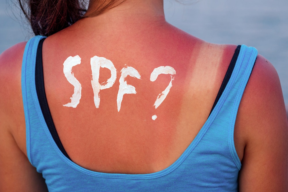 verbrannte weibliche Haut in der Sonne Großaufnahme in einem blauen T-Shirt